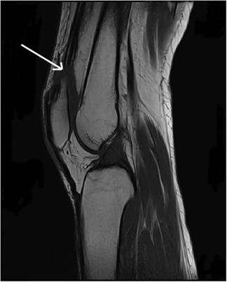 Rebuilding strength: surgical intervention and rehabilitation for bilateral spontaneous quadriceps tendon rupture—a case report